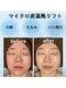 インナーグロウ 中目黒(INNER GLOW)の写真/30代からの「落ちてきた？」を速攻ケア！最新鋭のマイクロ波×レッドショットで、自分史上最高の小顔へ♪