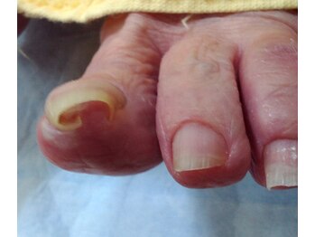 ドクターネイル爪革命 秋津店/変形した爪