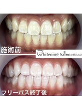 ホワイトニングサロン 京都烏丸店/ホワイトニング施術例