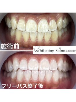 ホワイトニングサロン 京都烏丸店/ホワイトニング施術例