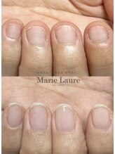 マリーロール 天王寺店(Marie Laure)/自爪育成/深爪矯正/ネイルケア