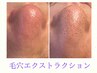究極の毛穴エステ！【エクストラクションスペシャルコース】¥12000→8800