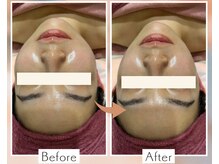 1番人気【むくみ・二重アゴ】解消－3kg見え小顔ハーブピーリング