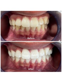 サロンニウ(salon_niu.)/６回目の症例（２０代男性）