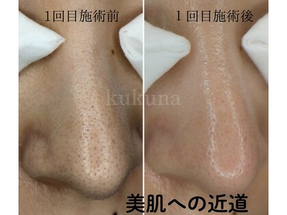 ククナ(kukuna)の写真