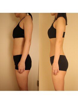 クライオ360(Cryo360)/脂肪冷却ビフォーアフター