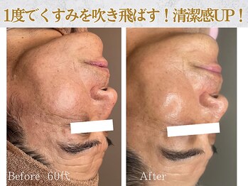 ぷるる 練馬 江古田/60代 ララピール+ゲルマスク