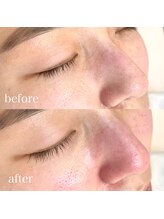 ネイルアイサロンアンドスクール リッカ(Lycka)/毛穴洗浄ビフォーアフター