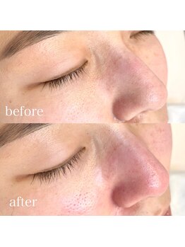 ネイルアイサロンアンドスクール リッカ(Lycka)/毛穴洗浄ビフォーアフター