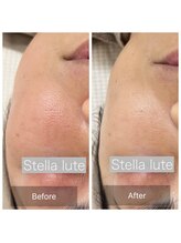 ステラルーテ(Stella lute)/ハーブ施術3回で毛穴が！