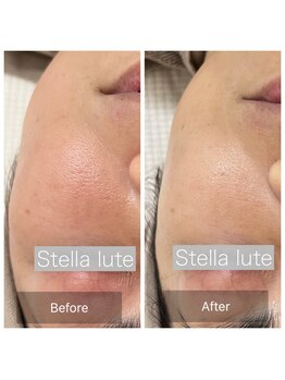 ステラルーテ(Stella lute)/ハーブ施術3回で毛穴が！