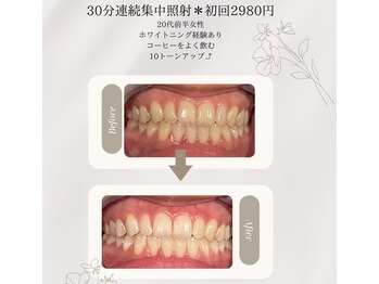 プラスビーセルフ(+b self)/ホワイトニングビフォーアフター