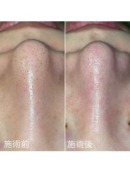 クレアーレ(creare)/ハイドロスキン・施術結果 3