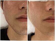 クリア 尾張旭店(Clear)/【Clear脱毛ビフォーアフター】