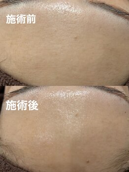 ツール(TOOL)/ハーブピーリング