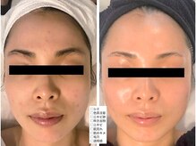 アンシャンテ 神戸元町店(Enchante)/毛穴洗浄ピーリングフェイシャル