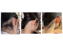 らたす(Ra+)/うなじ、襟足脱毛