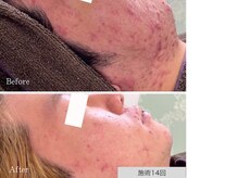 ニキビ研究所 千葉店/もうニキビや跡で悩まない肌へ！