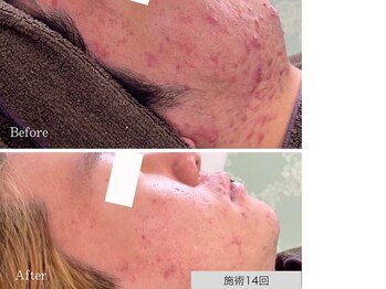 ニキビ研究所 千葉店/もうニキビや跡で悩まない肌へ！