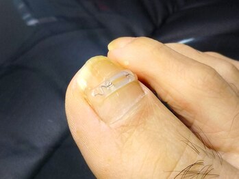 ドクターネイル爪革命 秋津店/巻き爪ケア