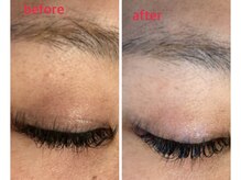 リル(RIRE)/まぶたのビフォーアフター