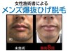 男性人気NO.1♪■メンズ爆抜ひげ脱毛■初回半額