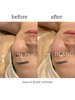 サロン ド ブラン アオヤマ(Salon de BLANC AOYAMA)/リフトアップで輪郭も整える