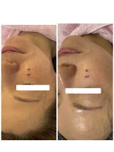 メディカルエース(MedicalAce)/ほうれい線や気になる箇所へ