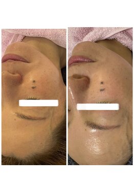 メディカルエース(MedicalAce)/ほうれい線や気になる箇所へ