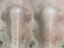 ヴィーヴ 京橋(vive)/【韓国式3D毛穴洗浄】