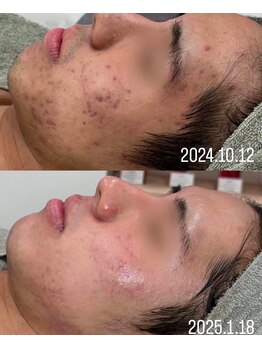 ミリ(MiLi)/剥けるハーブピーリング