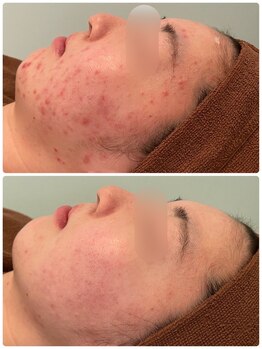 ビオプラス(BioPlus+)/ハーブピーリング/川崎