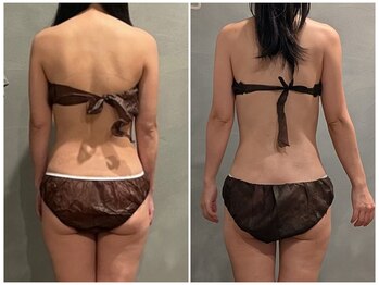 ツーアップ(2up)/筋膜リリースで背中美人