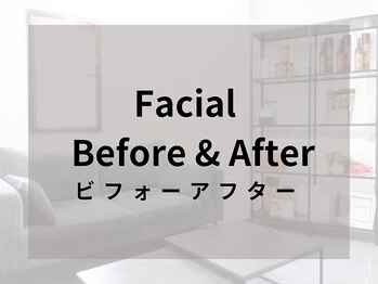 リライブ 亀有店(Re:Lives)/小顔・美肌のBefore&After♪