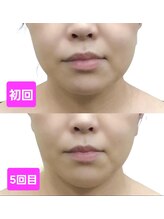 創業約23年の実績&北海道から沖縄まで全国店舗展開の実績!とてもソフトな施術なのに引締まった小顔に !