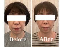 サロンベイビー 西宮本店(Salon Baby)/【BeforeAfter】小顔美容整顔