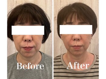 サロンベイビー 西宮本店(Salon Baby)/【BeforeAfter】小顔美容整顔