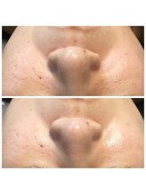 アウラ(AURA)/ダクトピール　before/after