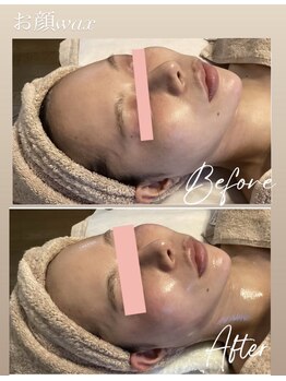 ソラ 六本松店(SORA)/お顔のWax脱毛