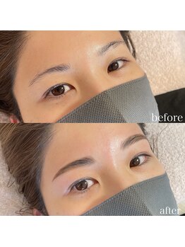 ダリ(Dali)/HBL×全顔脱毛