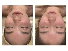 ブーケ(Bouquet)/左右非対称◆歪みケア