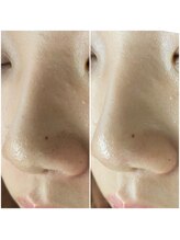 フィールカブ 仙川(feel kab)/毛穴の黒ずみ、開きを改善