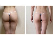 マンナ(Manna.)の雰囲気（1ヵ月集中痩身コース(4回)劇的ヒップアップ！）