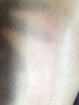 スタジオ ビープラス(STUDIO Bee+)/うなじ&背中のお得なセット