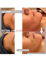 アンナカルナ(AnnaCarna)/揺らぎ肌は土台作りからスタート