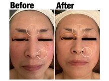 エステティックサロン アンジュ(Angu)の雰囲気(60代のお客様!お肌のシワ、たるみが2年後には若々しい素肌に!)