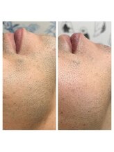 アンジェリーナ/30代/ヒゲ脱毛/6回