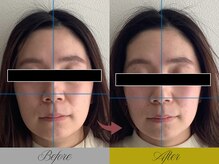 リン 大宮院(RIN)/小顔矯正の変化（担当：内田）