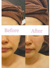 ブランシェ 野々市店 × 椿/シワ・たるみケア　お客様