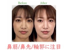 ラプリ 福岡博多店(Raplit)/隆鼻+輪郭・小顔矯正 美鼻/小顔